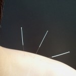 acupuncture