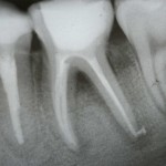 root canal