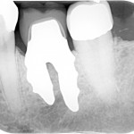 zirconia implant x-ray 36