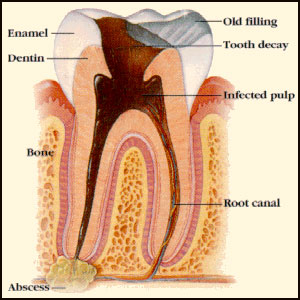 Cavitations & Root Canals – Interview With Dr. Meinig and Dr. LaMarche