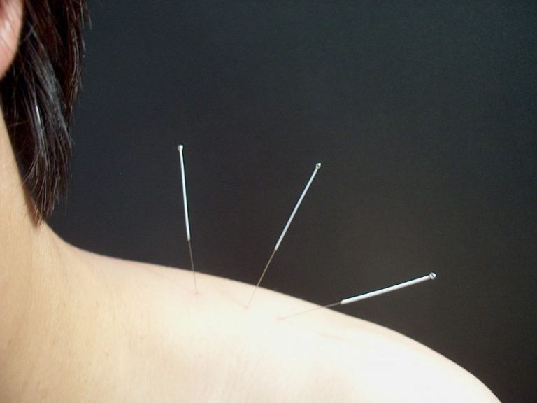 Acupuncture – What is it