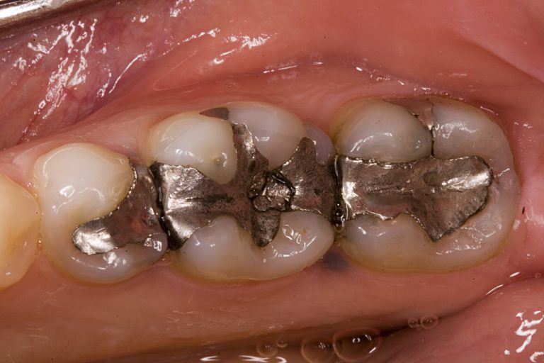 Mercury fillings danger