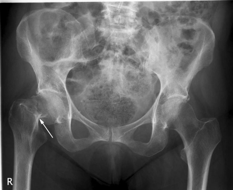Connection Between Fractured Hips And Heart Burn Drugs