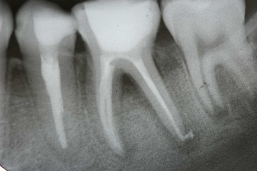 root canal1